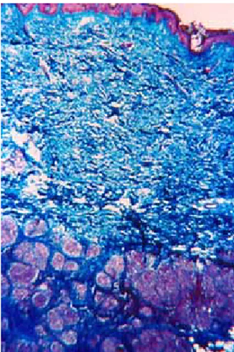 Figura 3. Microfotografía  H/E 40X. Granuloma sarcoidal consti- consti-tuido por células epitelioides sin corona de linfocitos