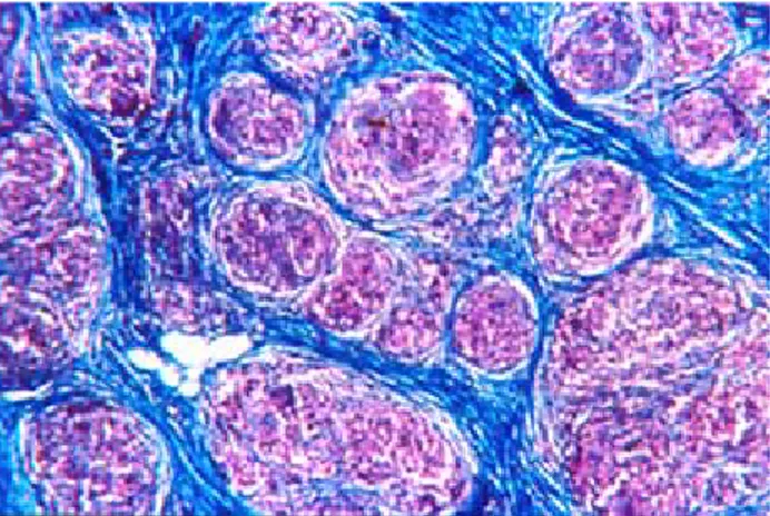 Figura 5. Tricrómico de Masson 20X. Numerosas células epitelioides que forman granulomas no caseosos sin infiltrado  pe-riférico, separados por tejido conectivo.