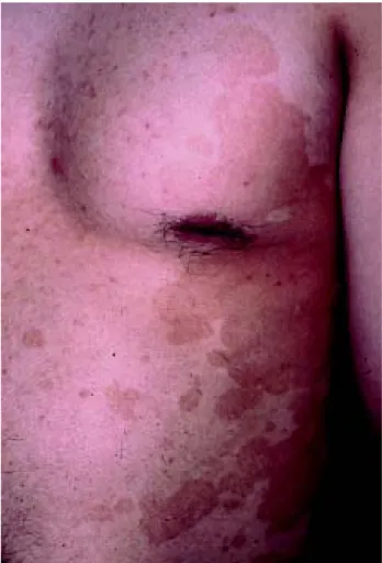 Figura 4. Pitiriasis versicolor hipo-hipercrómica.