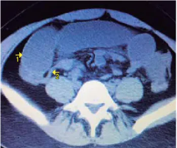 Figura 3. Lesión diverticular a 70 cm de la válvula ileocecal 