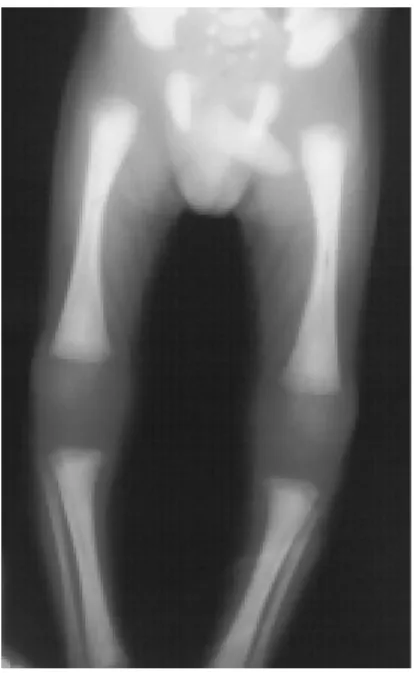 Figura 2. Lesiones óseas de las metá-