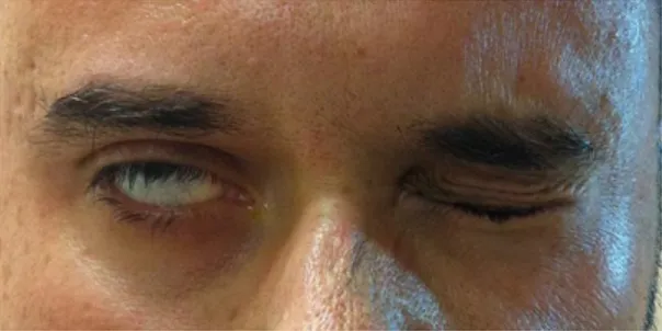 Fig. 25: Malfunción del cierre palpebral en ojo derecho. 