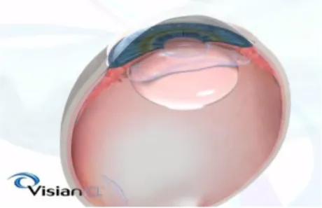 Figura 1. ICL fáquica de cámara posterior lugar de implantación. Visian.  (https://visianinfo.com/) 