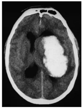 Ilustración 2: Hemorragia intraparenquimatosa de ganglios basales izquierdos, colapsa ventrículos laterales