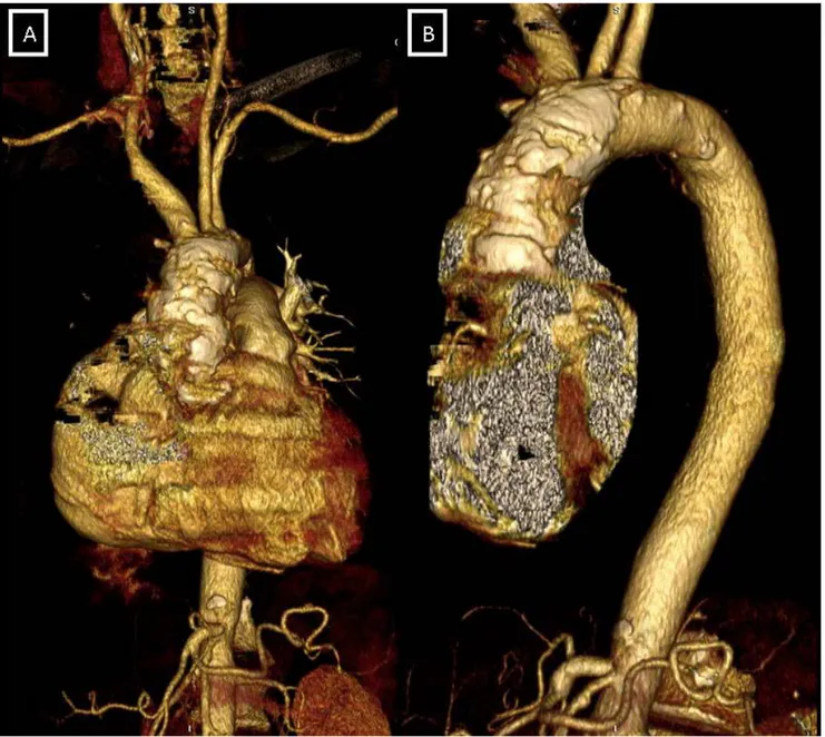 Figura 1: Reconstrucción tridimensional con tomografía computerizada que  muestra la calcificación difusa de la AoP (A: visión frontal; B: visión sagital)