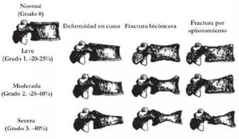 Figura 10. Índice de Genant en las fracturas osteoporóticas vertebrales. 