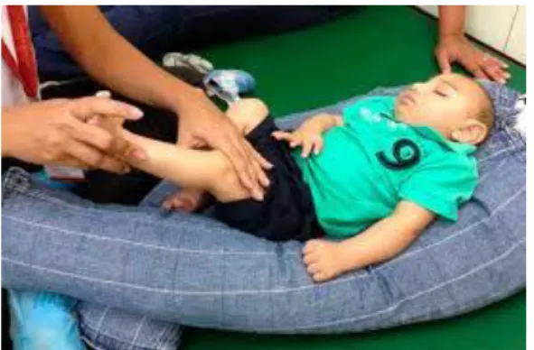 Foto 1. Espasticididad en niño con microcefalia.               