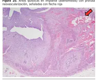 Figura 9. Adherencias sobre intestino y grasa mesometrial Figura 10.  Áreas quísticas en implante (adenomiosis) con profusa 
