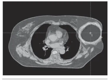 Figura 10. Imagen de APBI con la técnica de RT con intensidad mo- mo-dulada (IMRT).