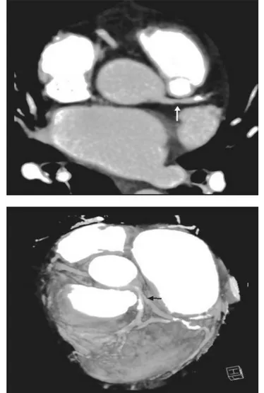 Figura 4. Angiografía coronaria por TC multidetector (TCMD). 4a.