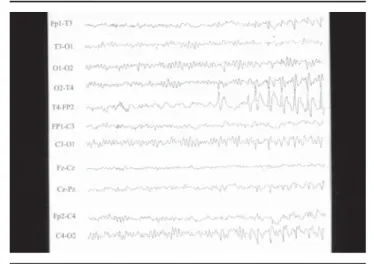 Figura 1. Epilepsia vestibular. Electroencefalograma con ondas agu- agu-das en el lóbulo temporal