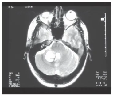 Figura 3. Hematoma hemisferio cerebeloso derecho por rotura de un cavernoma. RM cerebral, proyección axial