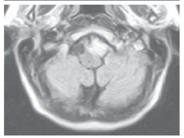 Figura 6. Malformación de Chiari tipo 1. RM cerebral, proyección lateral. Descenso de amígdalas cerebelosas hasta nivel C2 Figura 5