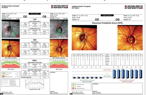Figura  16:  ejemplo  de  resultado  en  glaucoma  