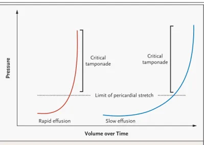 Figure 1.  Cardiac Tamponade.