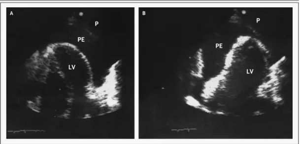 Figure 2.  Swinging of the Heart with a Large Pericardial Effusion (PE), Causing Electrical Alternation and Consequent  Tamponade.