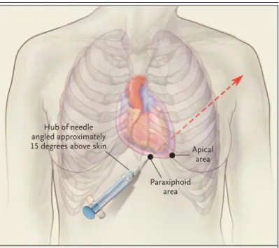 Figure 3.  Most Common Sites of Blind and Image-Guided Insertion  of the Needle for Pericardiocentesis.