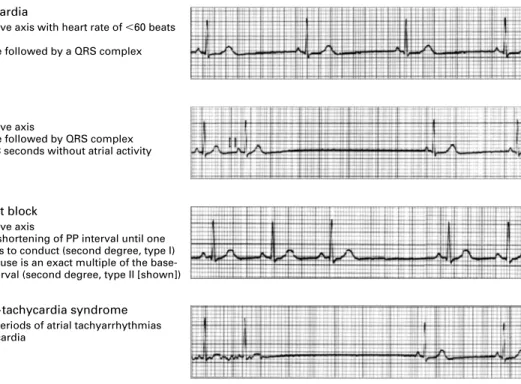 Figure 2.  Electrocardiographic Findings Associated with Sinus-Node Dysfunction.Sinus bradycardia9