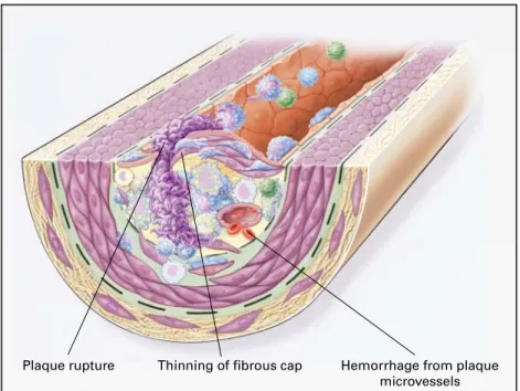 Figure 4. Unstable Fibrous Plaques in Atherosclerosis.