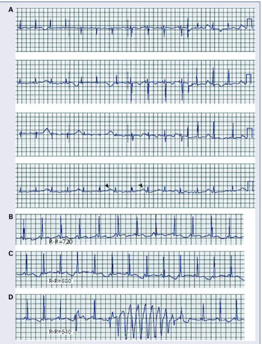 Figure 2. A. Twelve-lead ECG from a patient with hypokalemia and hypomagnesemia showing marked QTU prolon- prolon-gation and QTU alternans (marked by arrowheads); B–D