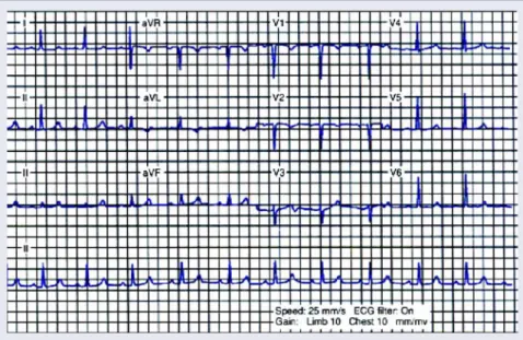 Figure 6. This 12-lead ECG is from a 24 year-old black female patient with sickle cell disease, end stage renal disease, and hyperparathyroidism