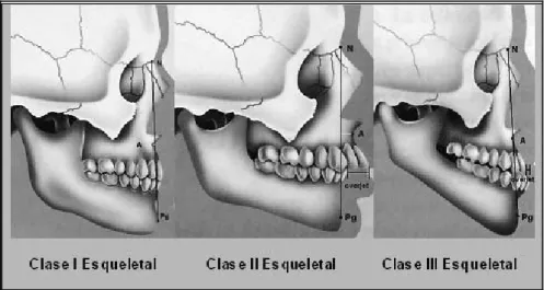 Figura 1 – Convexidad facial y overjet en clases I, II y III esqueletales