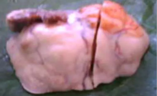Fig 1. Tumor de ovario
