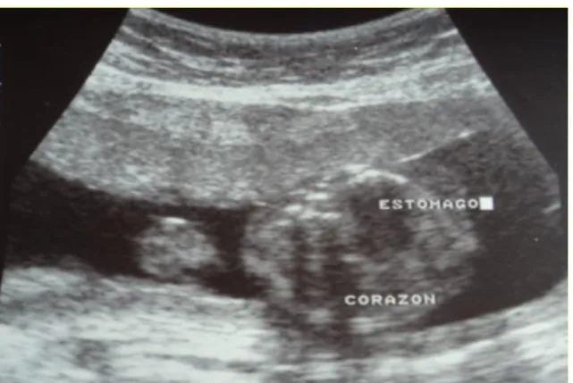 Fig 1. Corte coronal: corte transverso del tórax con una masa ecolúcida y 
