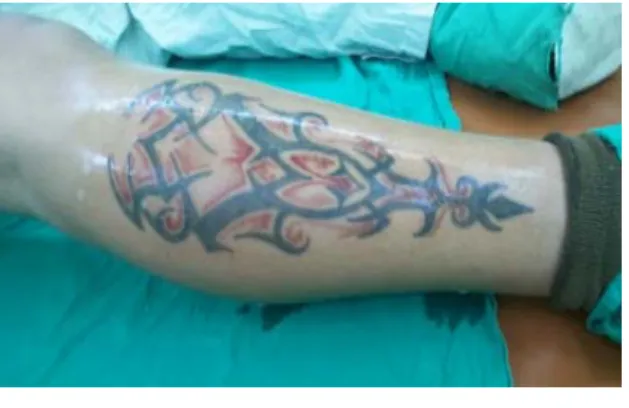 Fig 1. Tatuaje inicial  