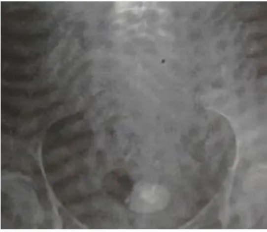 Fig. 1.  Litiasis en la vejiga 