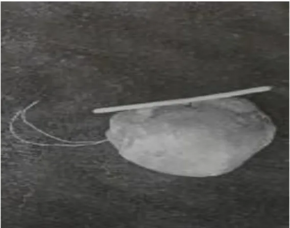 Fig. 2. Litiasis compactada unida a T de cobre  COMENTARIOS 