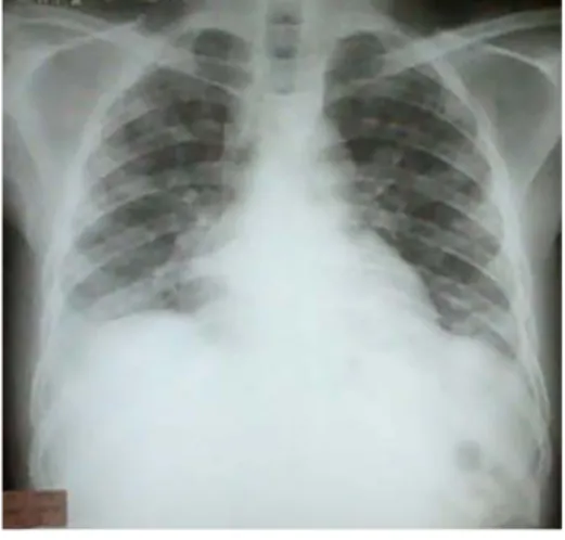 Fig. 1.  Neumonitis intersticial