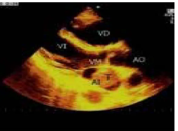 Fig. 2. Ecocardiografía transtorácica 