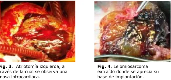 Fig. 4. Leiomiosarcoma  