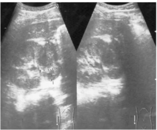 Fig 1. Ecografía con imagen compleja   en el polo inferior del riñón derecho 