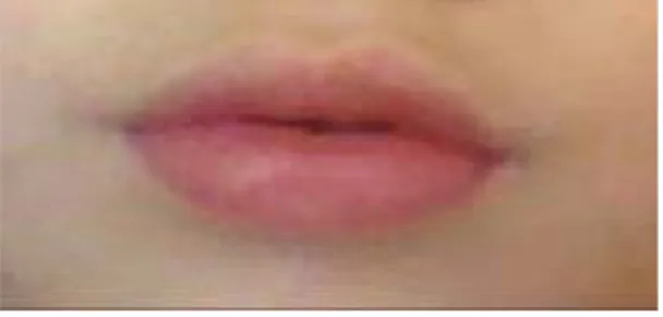 Fig 1. Labios agrietados 