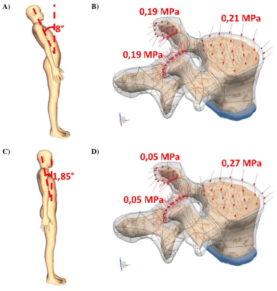 Figura 6. Posición del cuerpo y cargas ocasionadas sobre la vértebra L5. A) Extensión máxima, B) Cargas sobre la vértebra en caso de extensión má- má-xima, C) Extensión, B) Cargas sobre la vértebra en caso de extensión