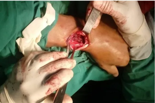 Fig.  2. Exposición del tumor. 