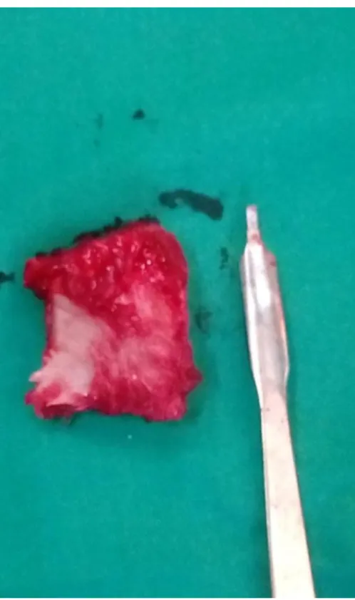 Fig. 4. Segmento óseo extraído de la cadera para injertar. 