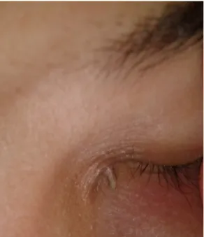 Fig. 1. Cuerno Cutáneo ojo izquierdo. 