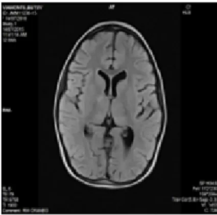 Fig. 1. Lesión hiperintensa en tálamo derecho 