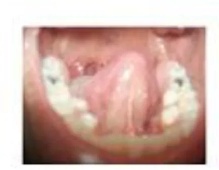 Fig. 2. Dientes supernumerarios en mandíbula.       