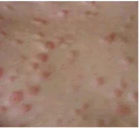 Fig. 1. Metástasis cutáneas múltiples 