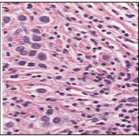 Fig. 3. Microfotografía con técnica de H/E que muestra núcleos en fila india.     La morfología con estas técnicas de rutina planteaba diagnósticos diferenciales, con  otras neoplasias por lo fue necesario realizar técnicas de inmuno-histoquímica como  rec