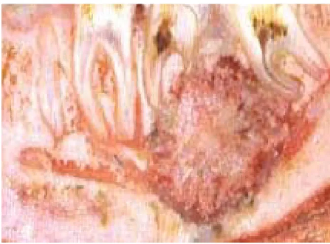 Fig. 2. Aspecto macroscópico de la lesión.      