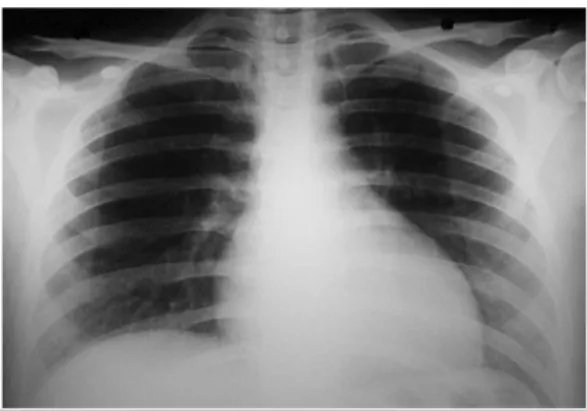 Fig. 1.  Rx de tórax posteroanterior.            