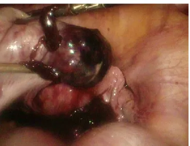 Fig. 2. Laparotomía abdominal del embarazo ectópico. 