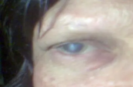Fig. 1. Ojo derecho.