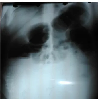 Fig. 2.  Rx de abdomen simple pretratamiento. Distensión del área cecal típico del  síndrome de Ogilvie