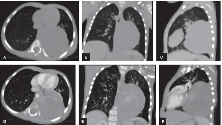 Figura 3. Tomografía de tórax de alta resolución. Se observa imagen sólida, ovoidea con bordes bien limitados en mediastino 